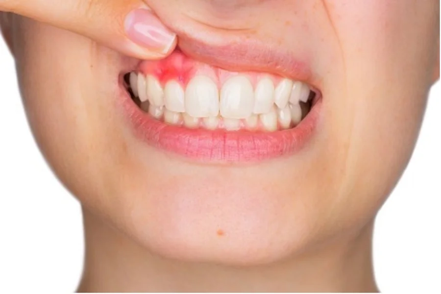 Treating Advanced Gum Disease With Expert Periodontal Care