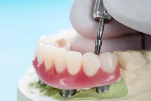 Technology Enhances Denture